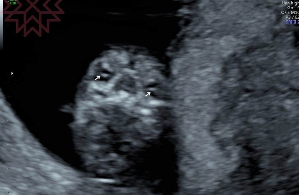 【懷孕12週】頸部透明帶+初唐,自費產檢項目,好多可愛超音波照! @小環妞 幸福足跡