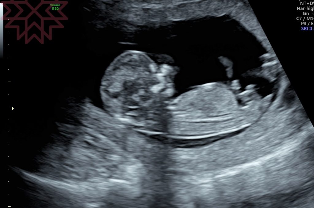 【懷孕12週】頸部透明帶+初唐,自費產檢項目,好多可愛超音波照! @小環妞 幸福足跡